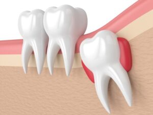 Wisdom-Teeth-min-768x576