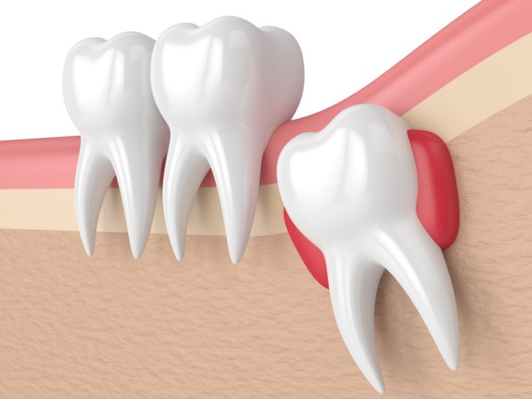Wisdom-Teeth-min-768x576