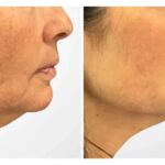 Best Plastic Surgeons in Dubai Known for Advanced Facial Thread Lift For Visible Skin Tightening