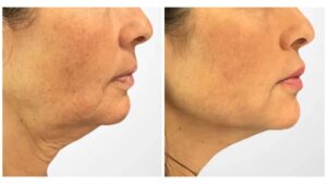 Best Plastic Surgeons in Dubai Known for Advanced Facial Thread Lift For Visible Skin Tightening
