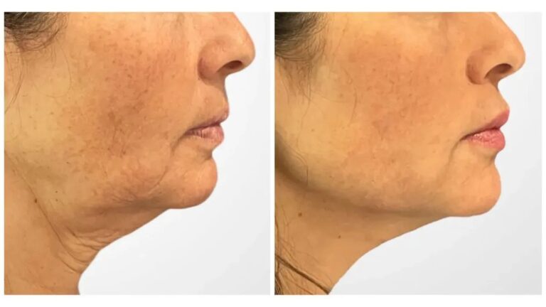 Best Plastic Surgeons in Dubai Known for Advanced Facial Thread Lift For Visible Skin Tightening