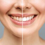 woman teeth before and after whitening over white