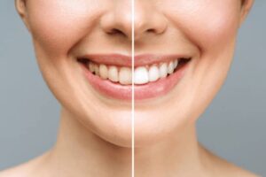 woman teeth before and after whitening over white