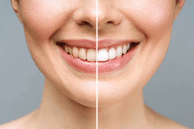 woman teeth before and after whitening over white