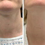 Radiofrequency (RF) Microneedling treatment in Dubai for Professional Skin Care
