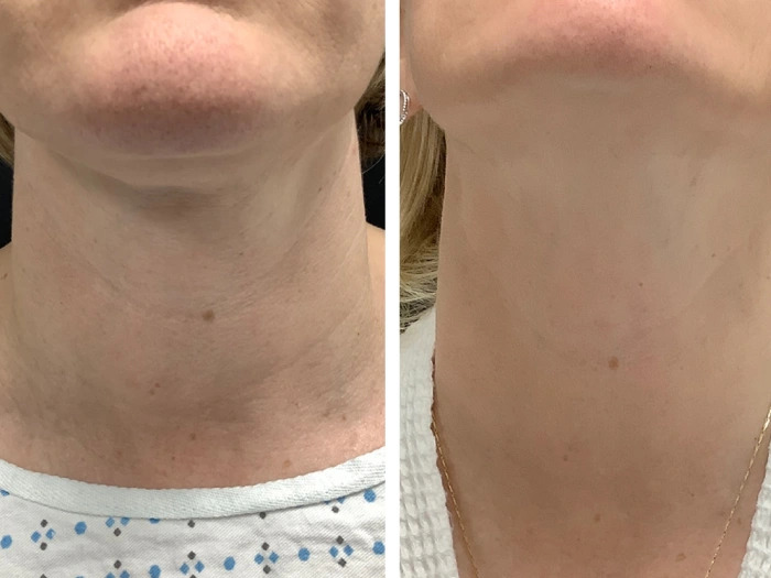 Radiofrequency (RF) Microneedling treatment in Dubai for Professional Skin Care
