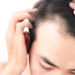 Hair Transplant in Dubai