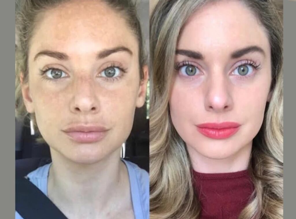 RF Microneedling in Dubai