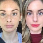 RF Microneedling in Dubai