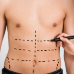 Laser Liposuction