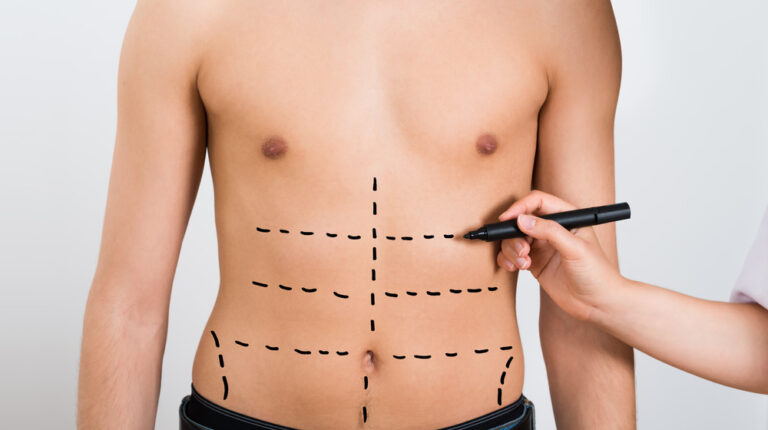 Laser Liposuction