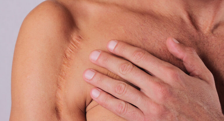 Surgical Scar Revision
