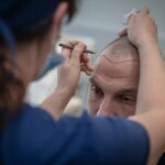Scalp Micropigmentation Dubai