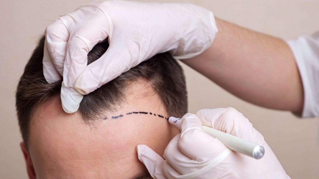 Stem Cell Hair Transplant in Dubai
