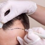 Stem Cell Hair Transplant in Dubai