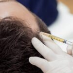 DHI Direct Hair Implant in Dubai