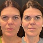 Best Plastic Surgeon in Dubai: Youthful Enhancement Through Thread Lift Procedures