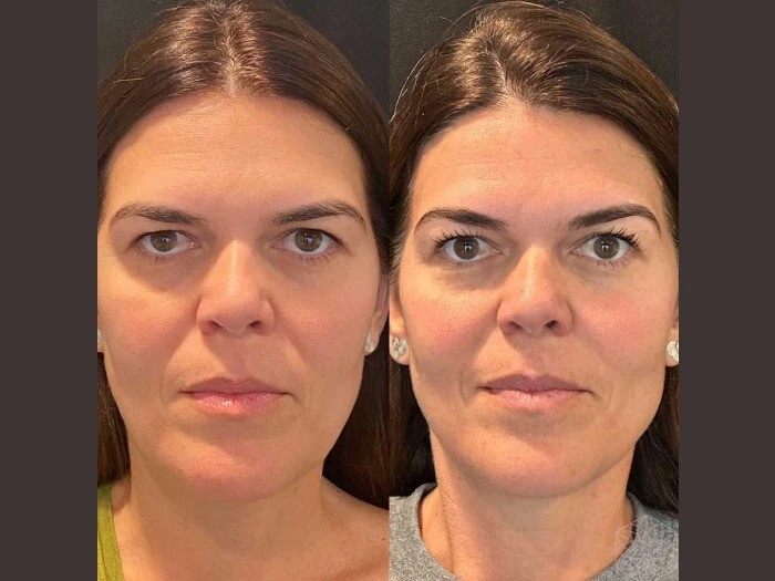 Best Plastic Surgeon in Dubai: Youthful Enhancement Through Thread Lift Procedures