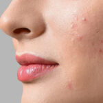 pimples_under_the_skin