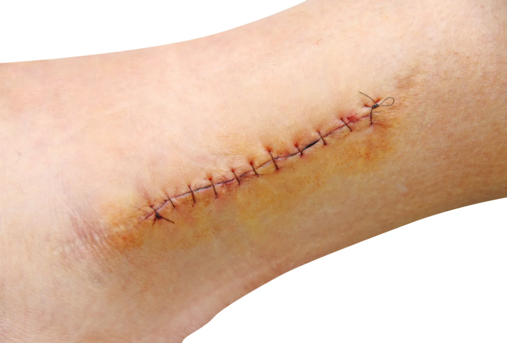 suture shutterstock_127350257-1-1536x1041