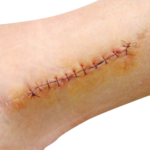 suture shutterstock_127350257-1-1536x1041