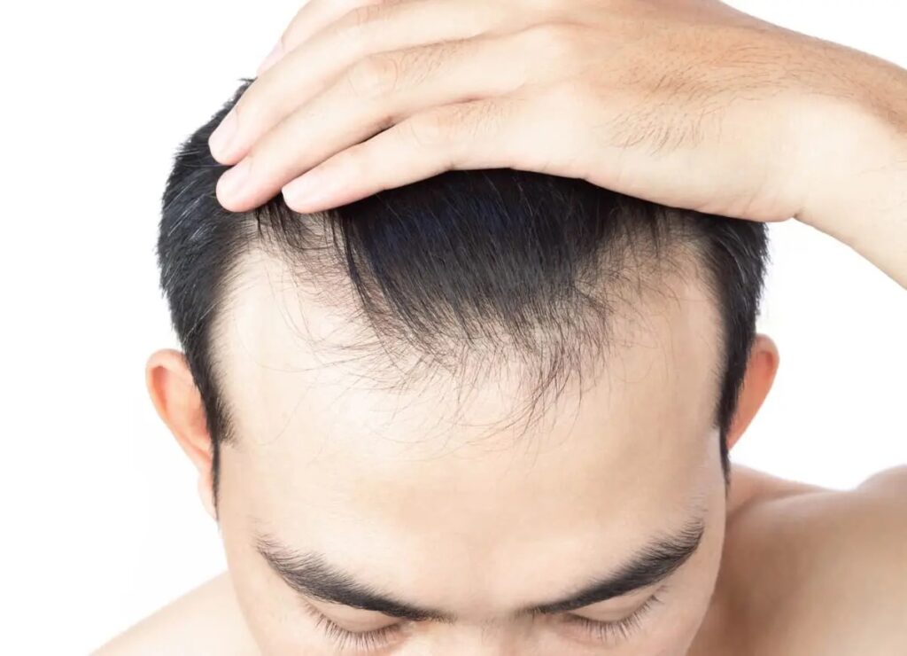 Hair Replacement in Dubai