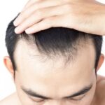 Hair Replacement in Dubai