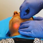 Endolift