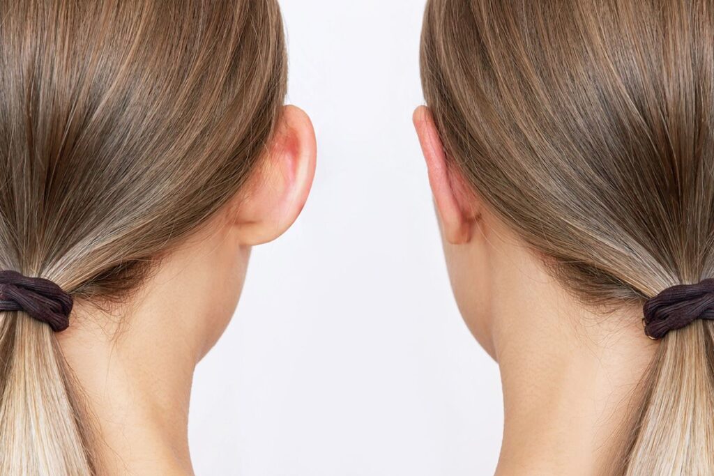 Factors to Consider When Choosing an Otoplasty Clinic
