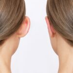 Factors to Consider When Choosing an Otoplasty Clinic