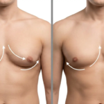 Gynecomastia Surgery