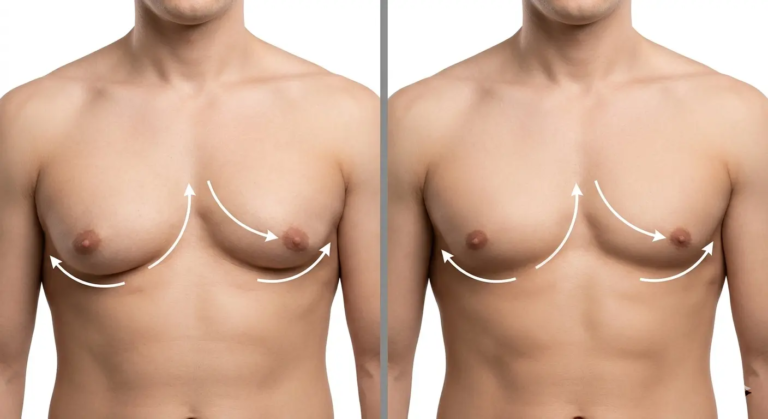 Gynecomastia Surgery