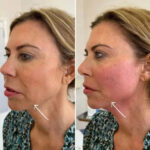 Best Doctors in dubai Delivering Advanced Endolift Facial Contouring Solutions