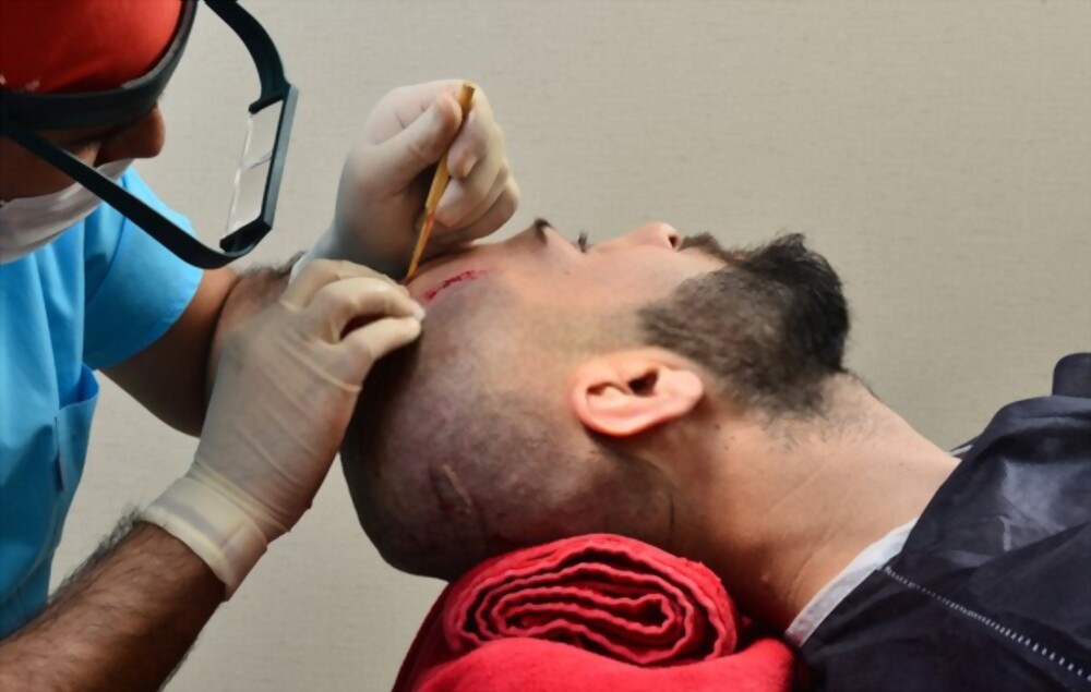 hair transplant in pune