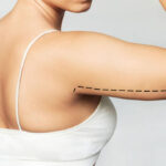 How Can the Right Clinic Improve Your Arm Lift Surgery Experience