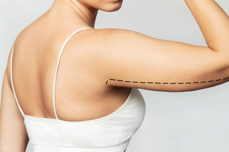 How Can the Right Clinic Improve Your Arm Lift Surgery Experience