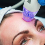Is RF Micro Needling the Best Skin Renewal Option?