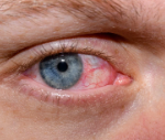 Dry Eye Syndrome in Delhi Causes Symptoms and Treatment