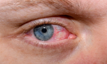Dry Eye Syndrome in Delhi Causes Symptoms and Treatment