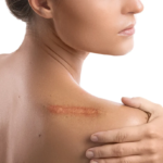 Surgical Scar Revision