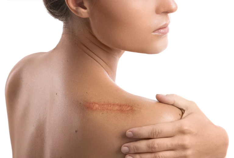 Surgical Scar Revision