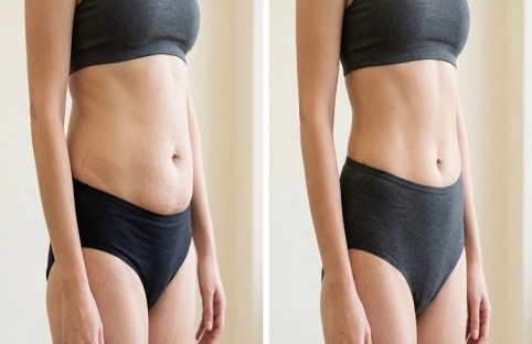 Liposculpture Dubai