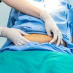 Why Quality Care Matters in Laparoscopic Surgery