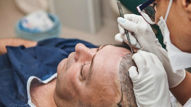 Hair Transplant Ras Al Khaimah