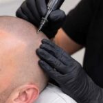 Scalp Micropigmentation Dubai