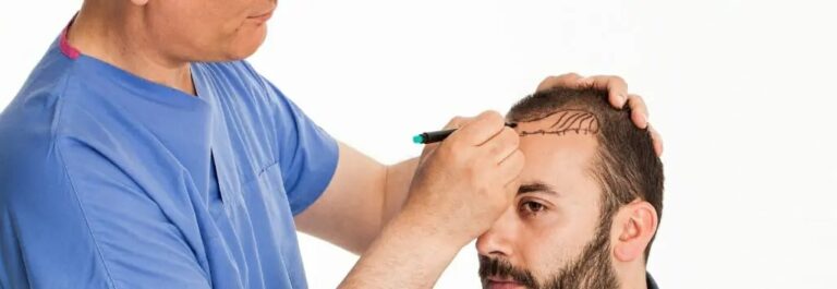 Stem Cell Hair Transplant in Dubai