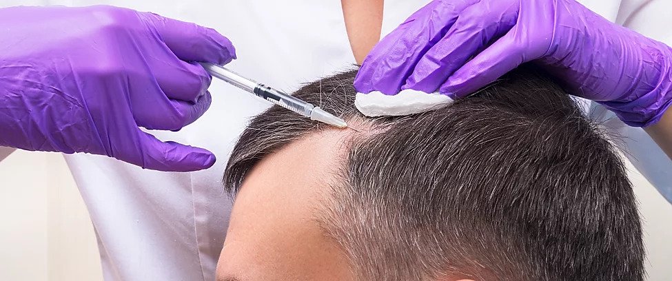 Hair Transplant in Dubai