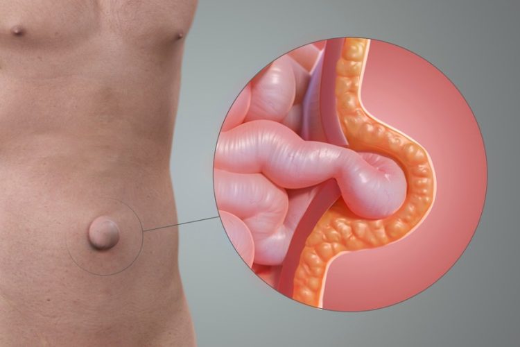 Best Hernia Surgeon in Navi Mumbai