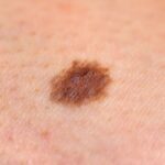 skin cancer