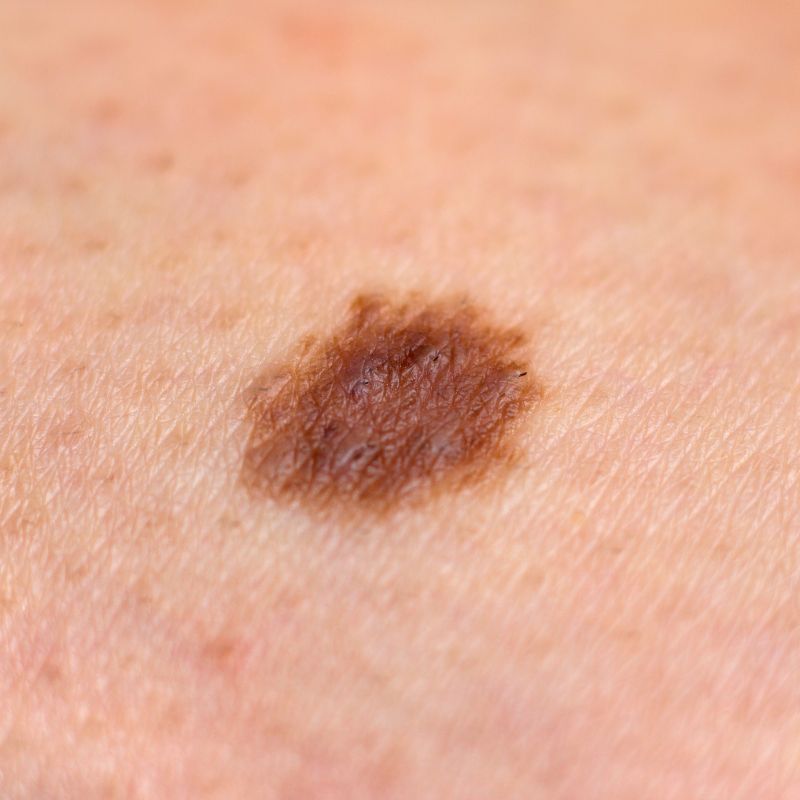 skin cancer
